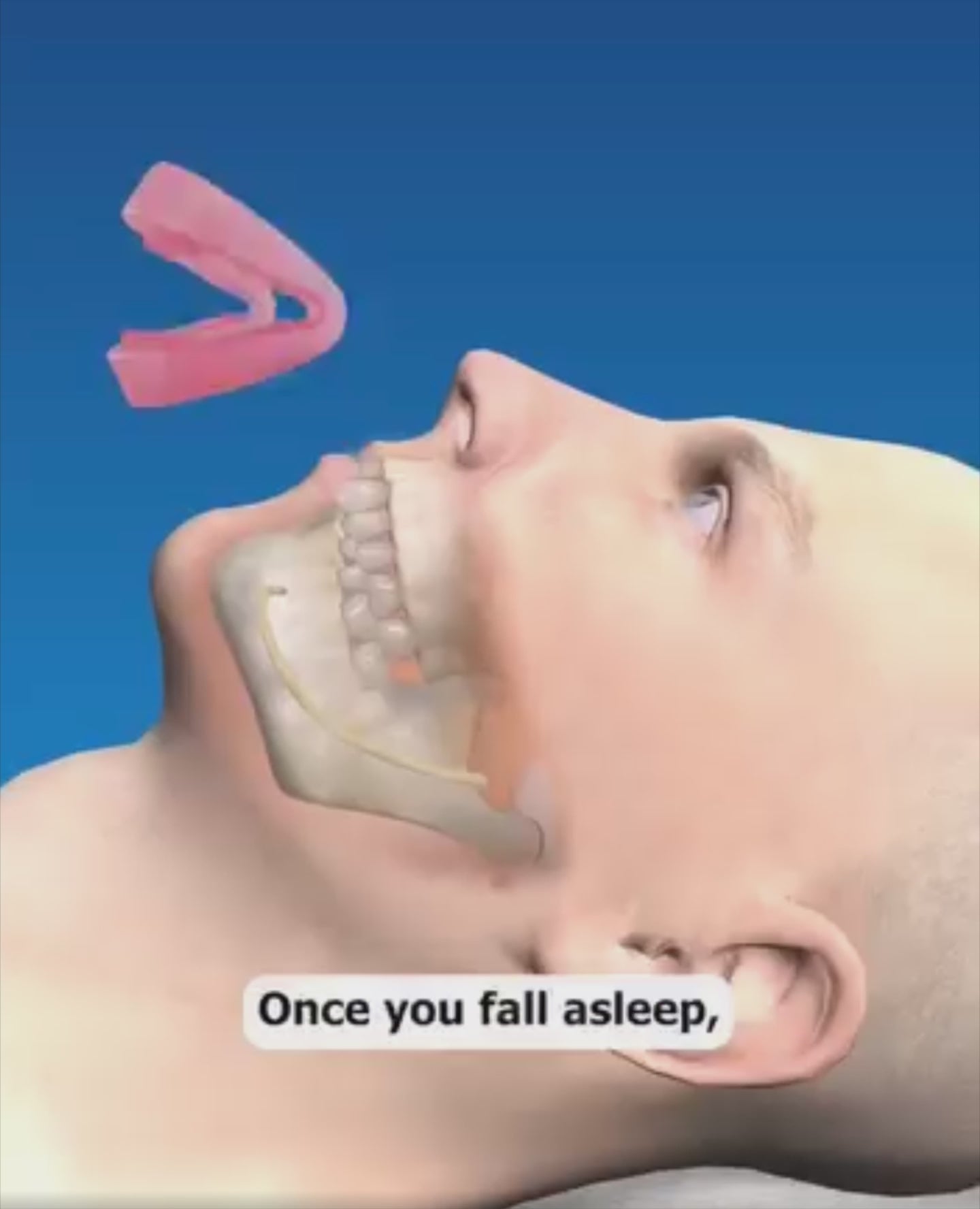 SilentRx Anti-Snoring Mouthpiece Universal Size